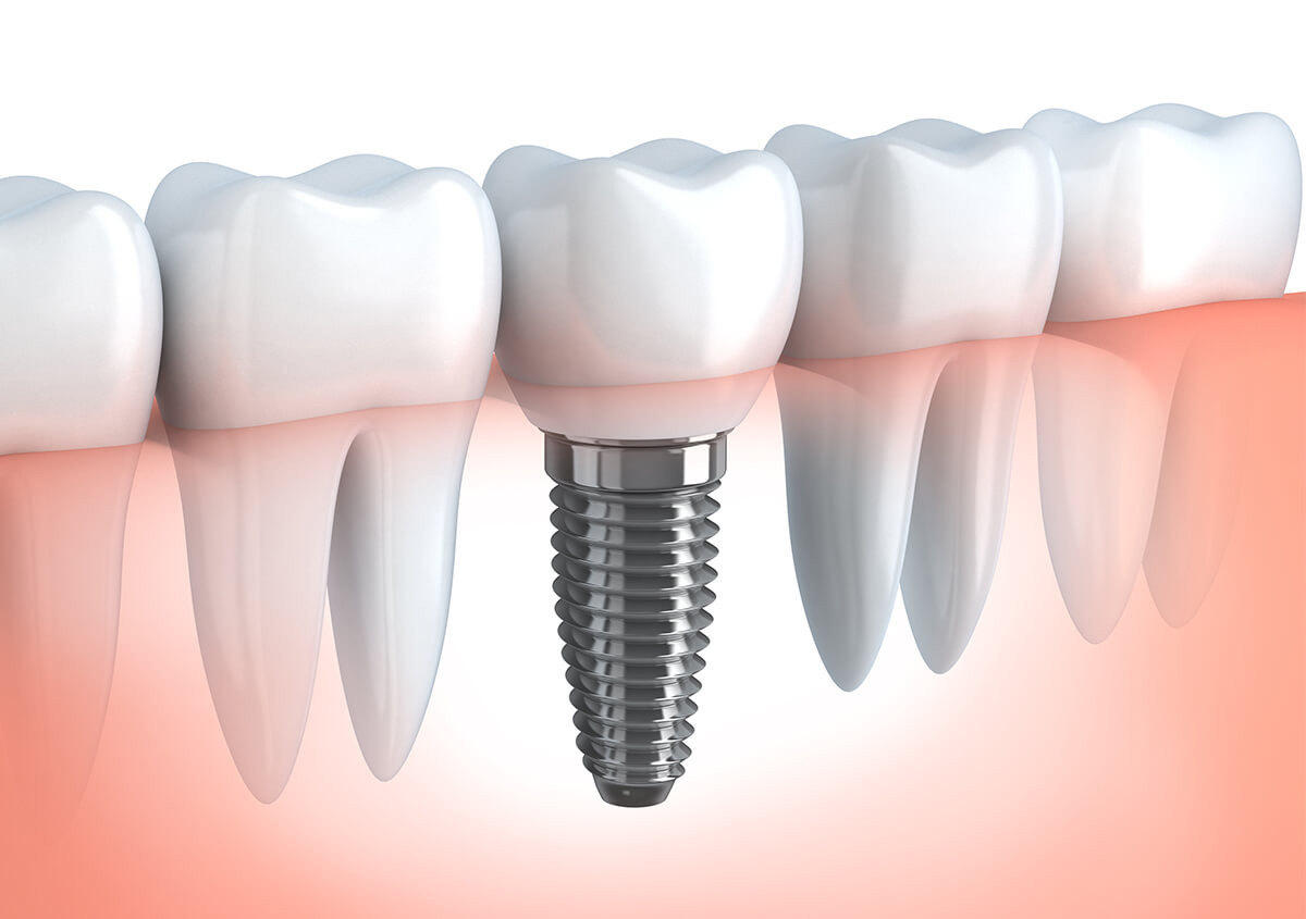 Dental Implants Dentist in Draper UT Area