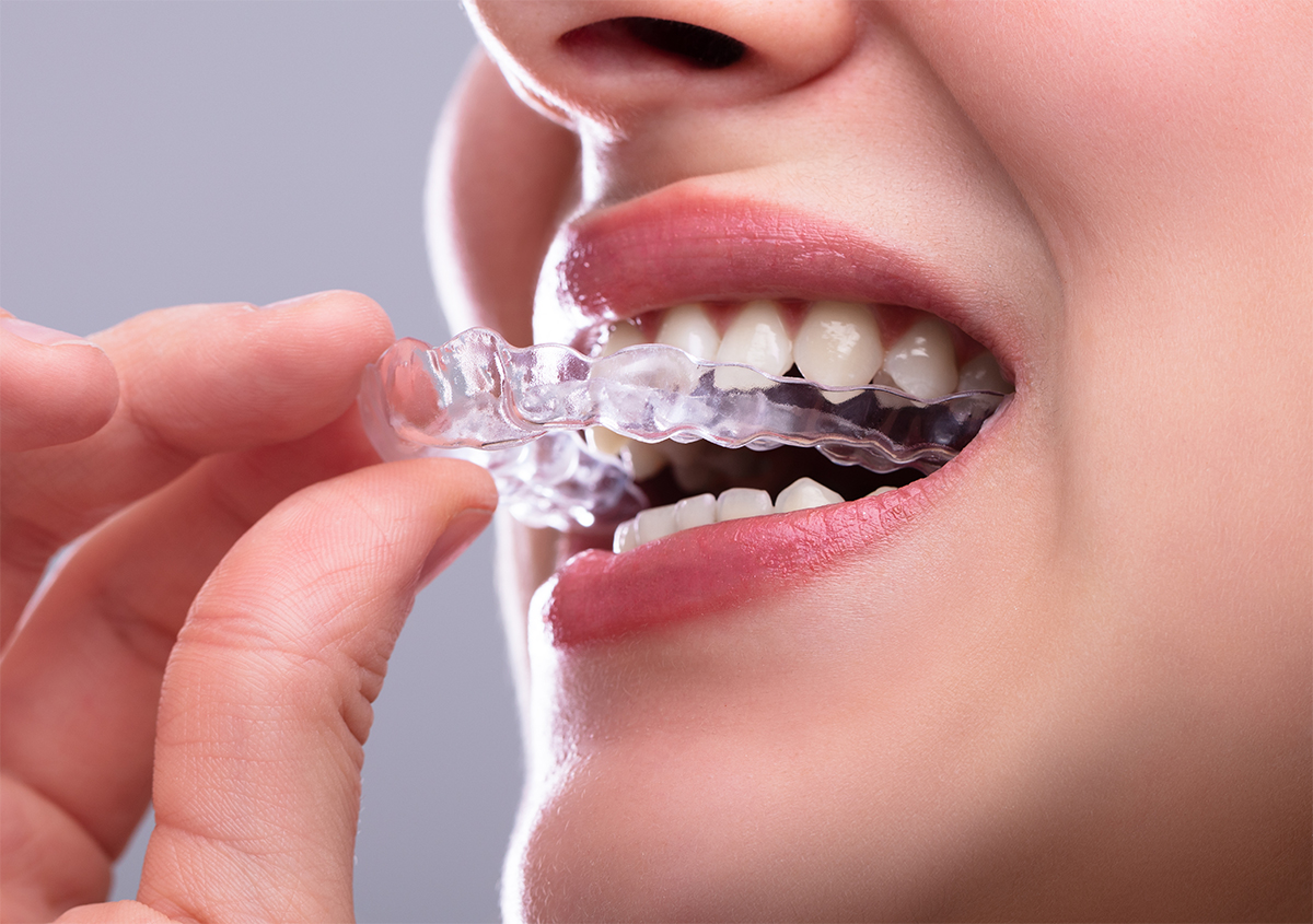 Teeth Straightening With Clear Aligners Instead Of Traditional Braces Using Invisalign