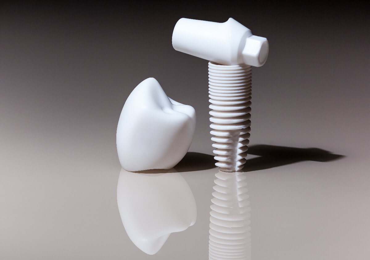 Tooth Replacement Option, Dental Implants in Draper UT area